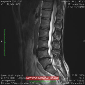 Lower Back Pain - herniated disc